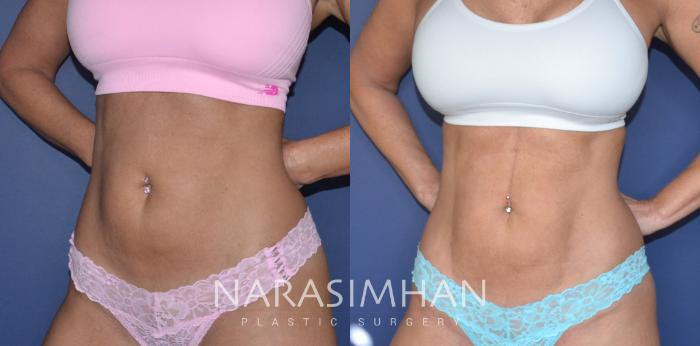 Before & After Liposuction Case 251 View #1 View in Tampa, Florida