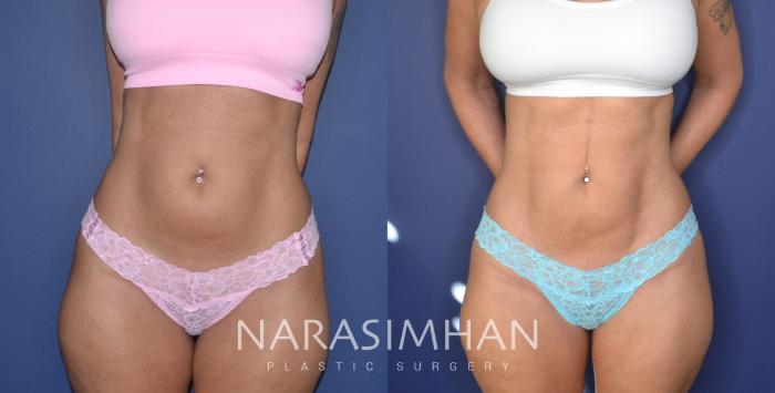 Before & After Liposuction Case 251 View #2 View in Tampa, Florida