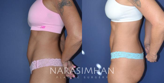 Before & After Liposuction Case 251 View #3 View in Tampa, Florida
