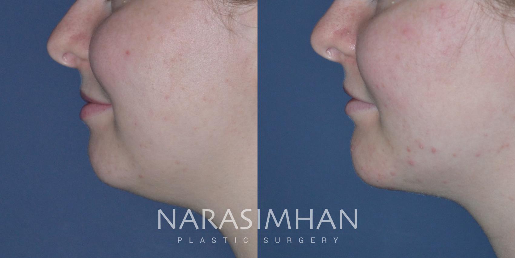 Before & After Necklift Case 272 View #1 View in St Petersburg, Florida