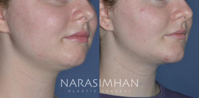 Before & After Chin Augmentation  Case 272 View #2 View in Tampa, Florida