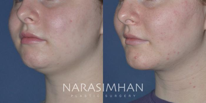 Before & After Chin Augmentation  Case 272 View #3 View in Tampa, Florida