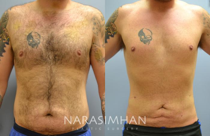 Before & After Liposuction Case 48 View #1 View in Tampa, Florida