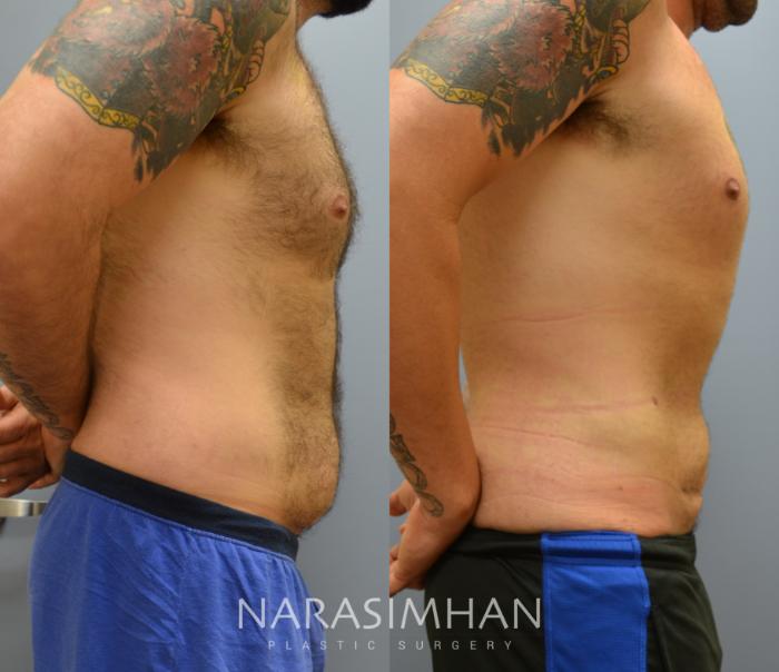 Before & After Liposuction Case 48 View #2 View in Tampa, Florida