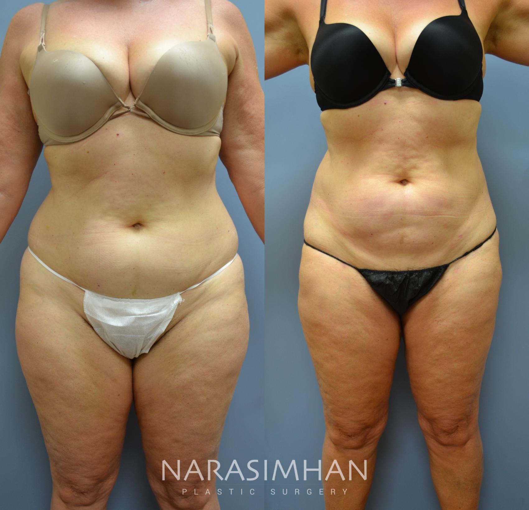 Before & After Liposuction Case 49 View #1 View in St Petersburg, Florida