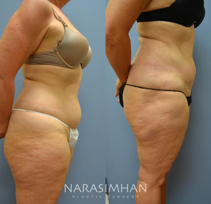 Before & After Liposuction Case 49 View #3 View in Tampa, Florida