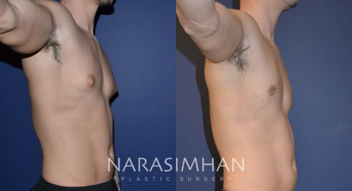 Before & After Male Breast Reduction (Gynecomastia) Case 154 View #1 View in St Petersburg, Florida