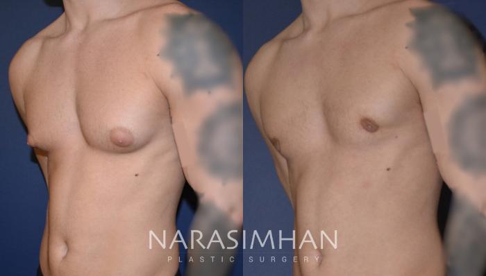 Before & After Male Breast Reduction (Gynecomastia) Case 154 View #2 View in Tampa, Florida