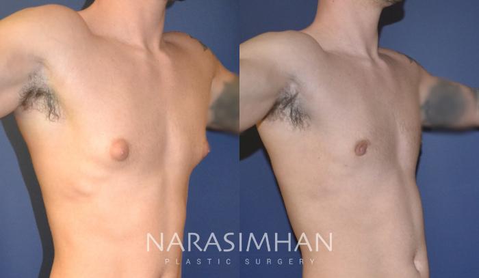 Before & After Male Breast Reduction (Gynecomastia) Case 154 View #3 View in Tampa, Florida