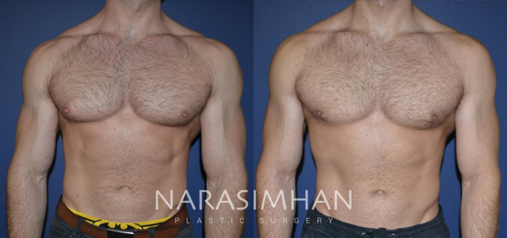 Before & After Male Breast Reduction (Gynecomastia) Case 158 View #1 View in St Petersburg, Florida