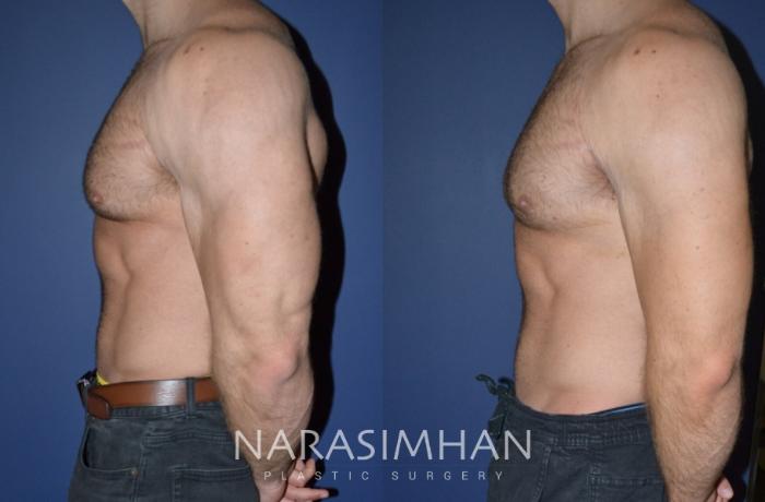 Before & After Male Breast Reduction (Gynecomastia) Case 158 View #3 View in Tampa, Florida