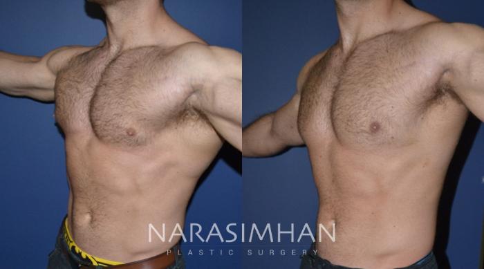 Before & After Male Breast Reduction (Gynecomastia) Case 158 View #4 View in Tampa, Florida