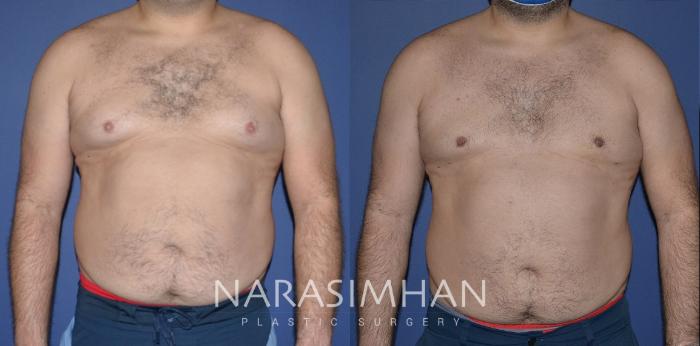 Before & After Male Breast Reduction (Gynecomastia) Case 196 View #1 View in St Petersburg, Florida