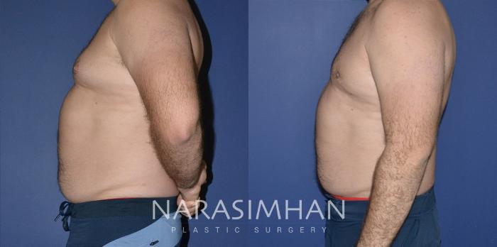 Before & After Male Breast Reduction (Gynecomastia) Case 196 View #2 View in Tampa, Florida
