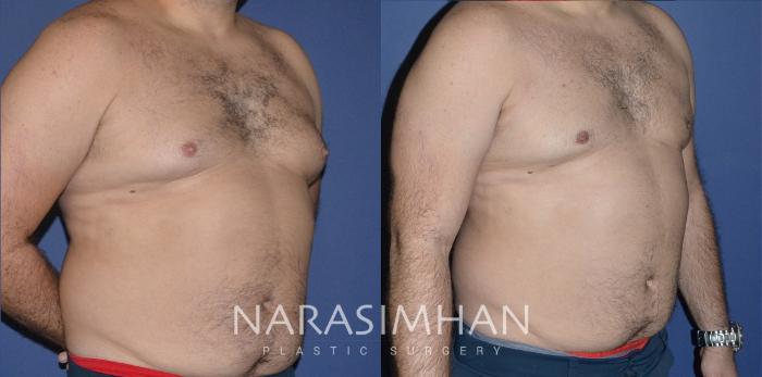Before & After Male Breast Reduction (Gynecomastia) Case 196 View #3 View in Tampa, Florida
