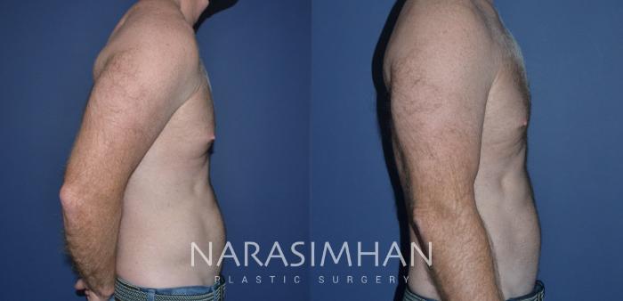 Before & After Male Breast Reduction (Gynecomastia) Case 221 View #1 View in St Petersburg, Florida