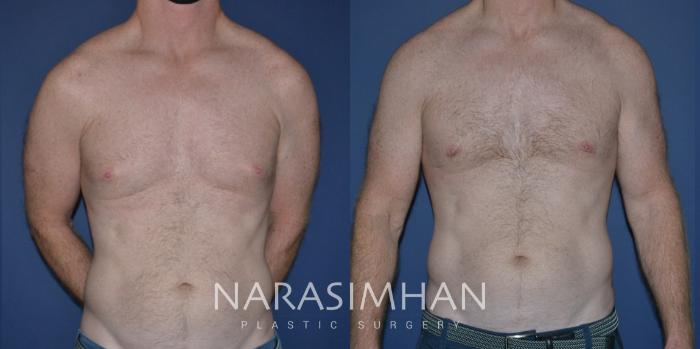 Before & After Male Breast Reduction (Gynecomastia) Case 221 View #2 View in Tampa, Florida