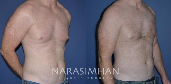 Before & After Male Breast Reduction (Gynecomastia) Case 221 View #3 View in Tampa, Florida