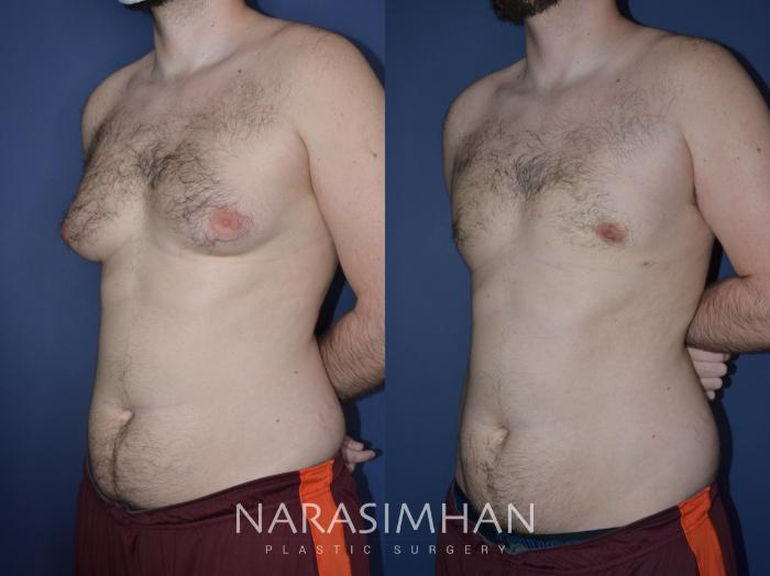 Before & After Male Breast Reduction (Gynecomastia) Case 225 View #2 View in Tampa, Florida