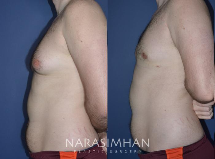 Before & After Male Breast Reduction (Gynecomastia) Case 225 View #3 View in Tampa, Florida