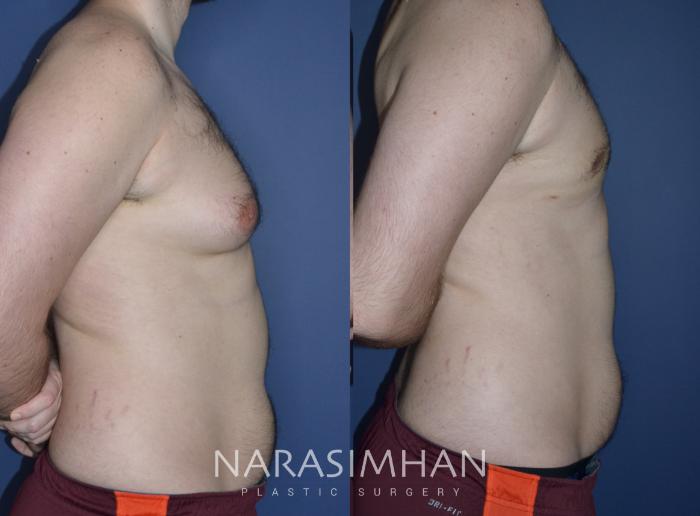 Before & After Male Breast Reduction (Gynecomastia) Case 225 View #4 View in Tampa, Florida