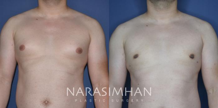 Before & After Male Breast Reduction (Gynecomastia) Case 271 View #1 View in St Petersburg, Florida