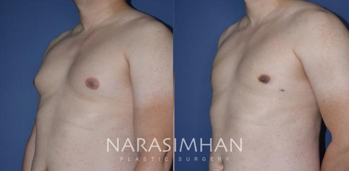 Before & After Male Breast Reduction (Gynecomastia) Case 271 View #2 View in Tampa, Florida
