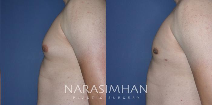Before & After Male Breast Reduction (Gynecomastia) Case 271 View #3 View in Tampa, Florida