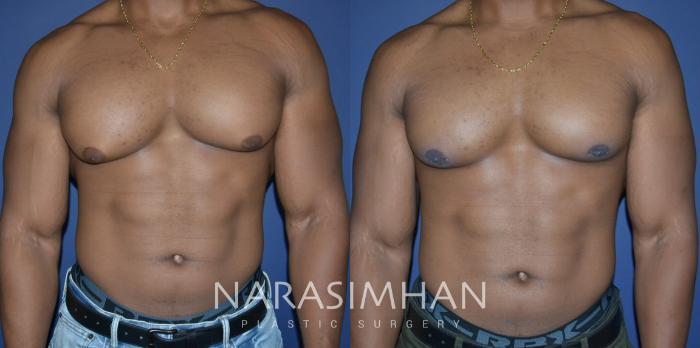 Before & After Male Breast Reduction (Gynecomastia) Case 288 Front View in Tampa, Florida