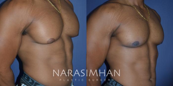 Before & After Liposuction Case 288 Right Oblique View in Tampa, Florida