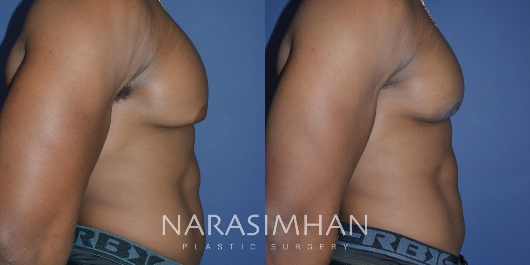 Before & After Male Breast Reduction (Gynecomastia) Case 288 Right Side View in St Petersburg, Florida