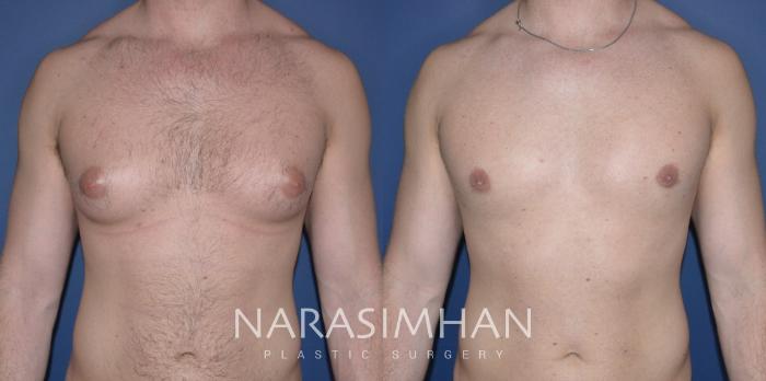 Before & After Male Breast Reduction (Gynecomastia) Case 311 Front View in Tampa, Florida