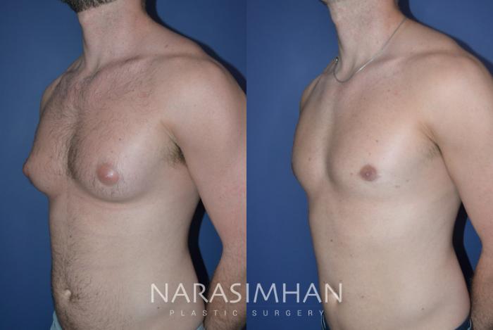 Before & After Male Breast Reduction (Gynecomastia) Case 311 Left Oblique View in Tampa, Florida
