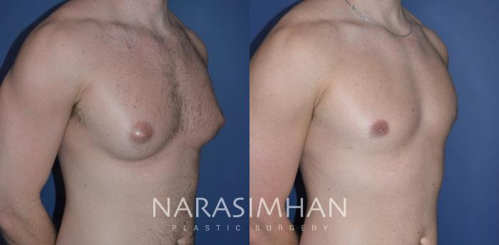 Before & After Male Breast Reduction (Gynecomastia) Case 311 Right Oblique View in Tampa, Florida