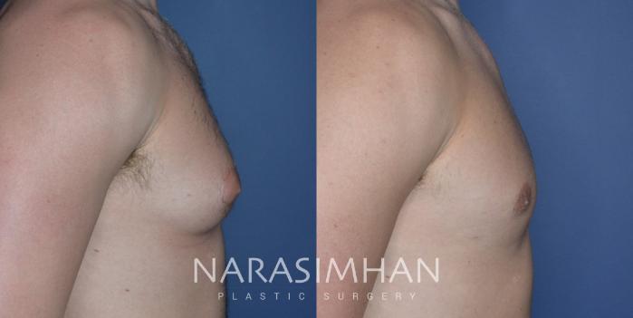 Before & After Male Breast Reduction (Gynecomastia) Case 311 Right Side View in Tampa, Florida