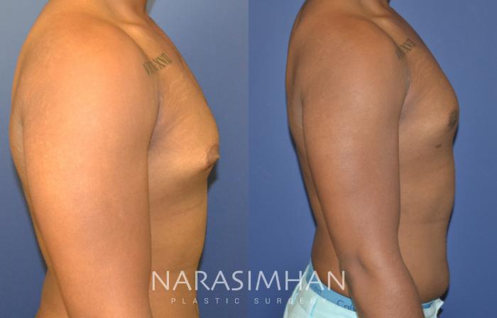 Before & After Male Breast Reduction (Gynecomastia) Case 74 View #2 View in Tampa, Florida