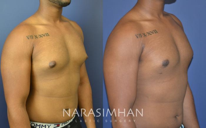 Before & After Male Breast Reduction (Gynecomastia) Case 74 View #3 View in Tampa, Florida