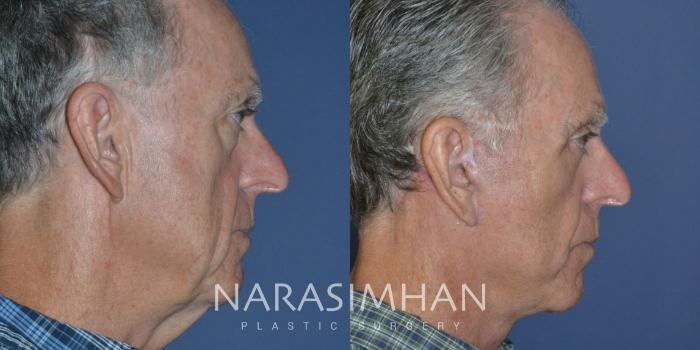 Before & After Male Facelift Case 248 View #1 View in St Petersburg, Florida