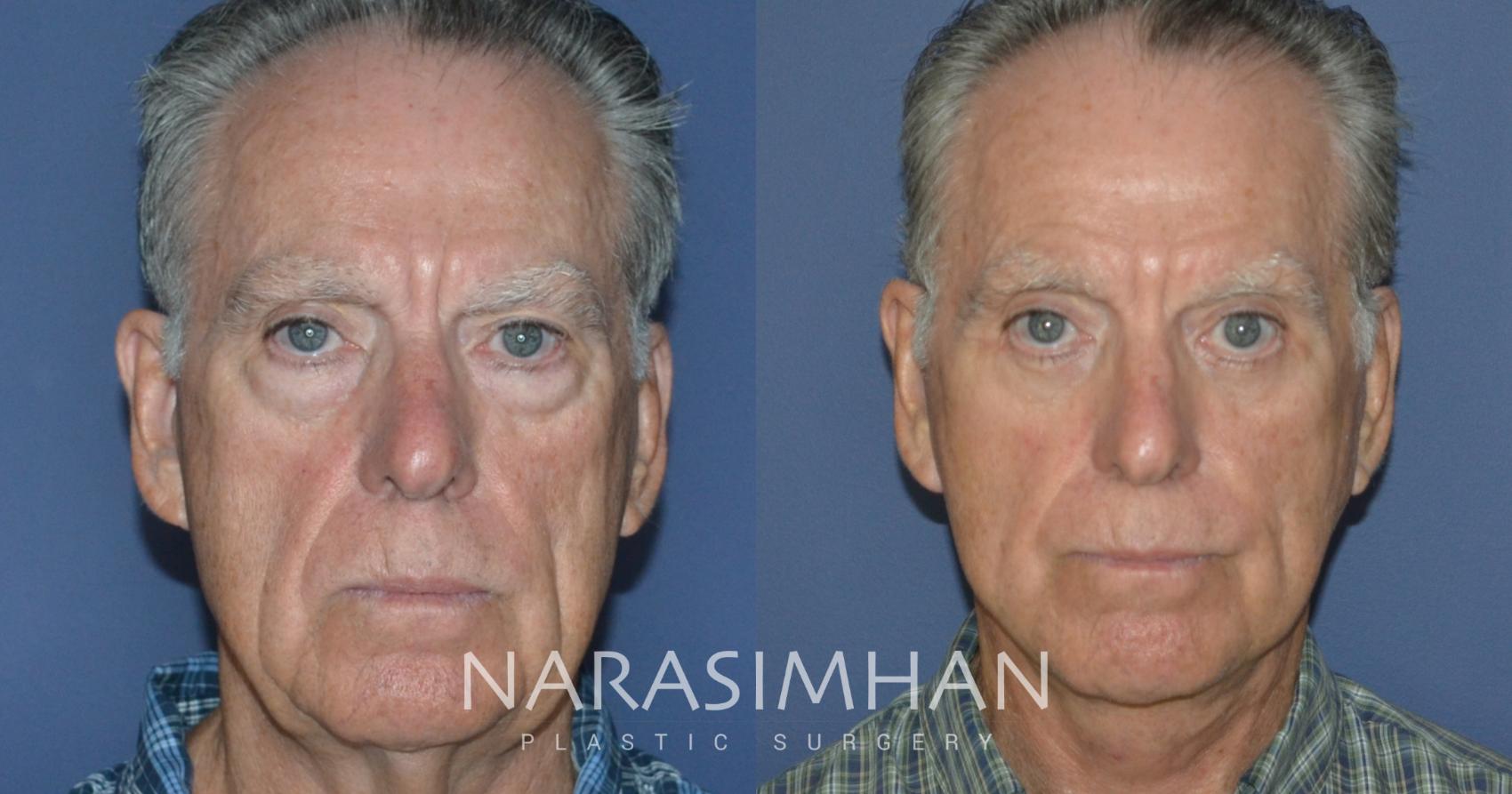 Before & After Male Facelift Case 248 View #2 View in St Petersburg, Florida