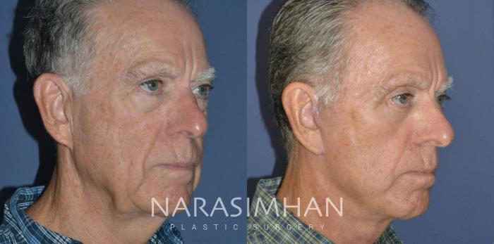 Before & After Male Facelift Case 248 View #3 View in St Petersburg, Florida