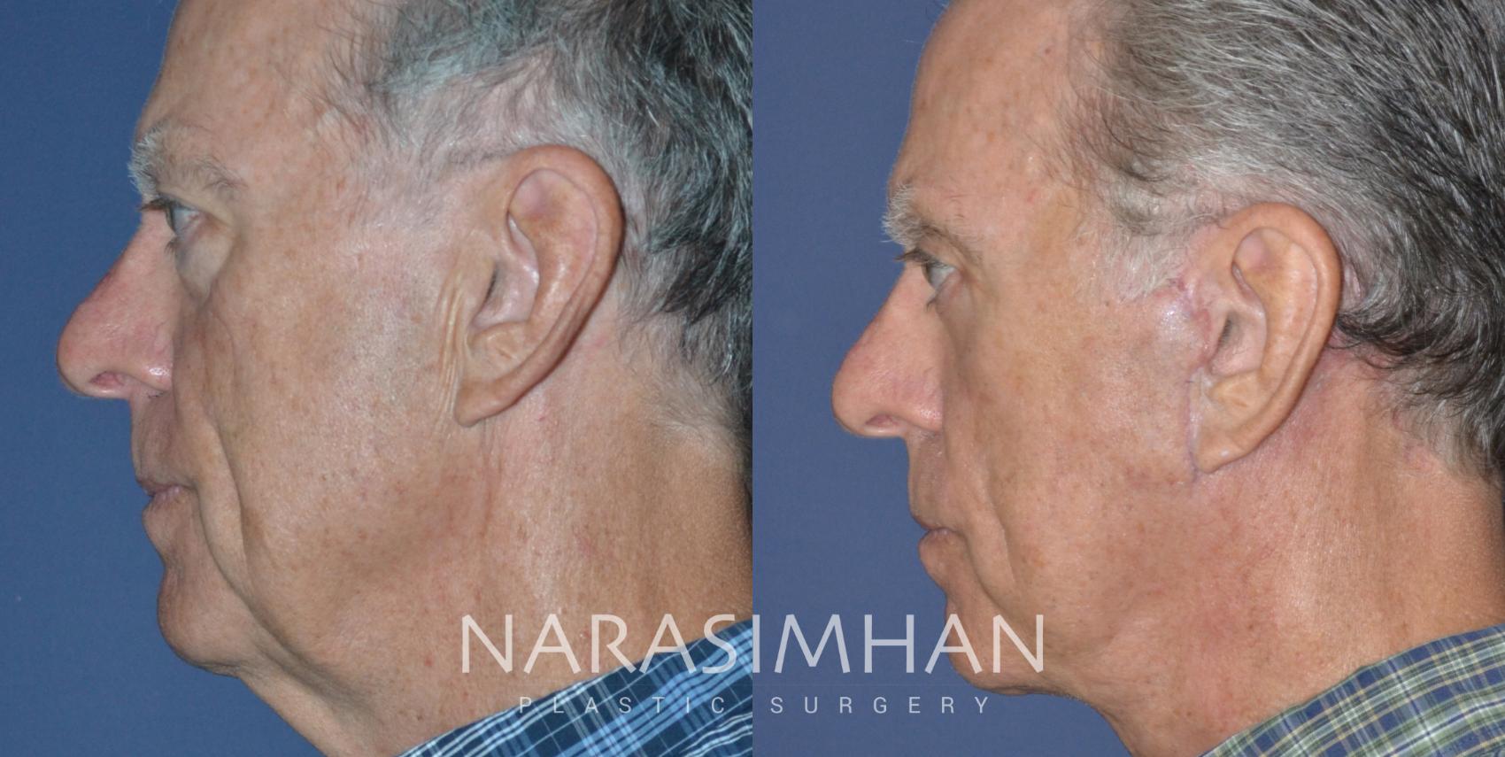 Before & After Male Facelift Case 248 View #4 View in St Petersburg, Florida