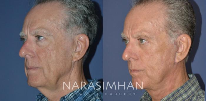 Before & After Male Facelift Case 248 View #5 View in St Petersburg, Florida