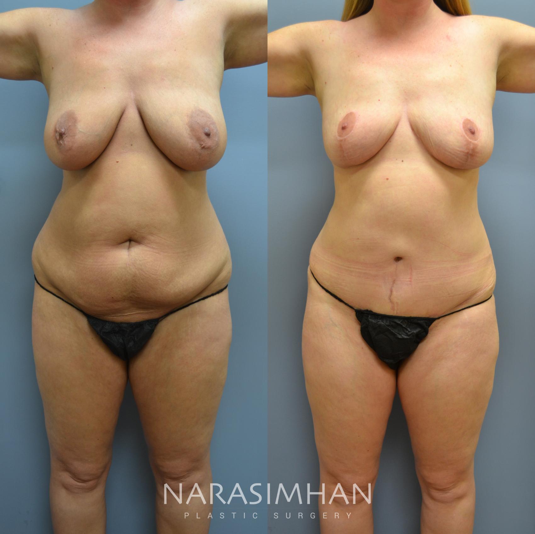 Before & After Tummy Tuck (Abdominoplasty) Case 10 View #1 View in Tampa, Florida