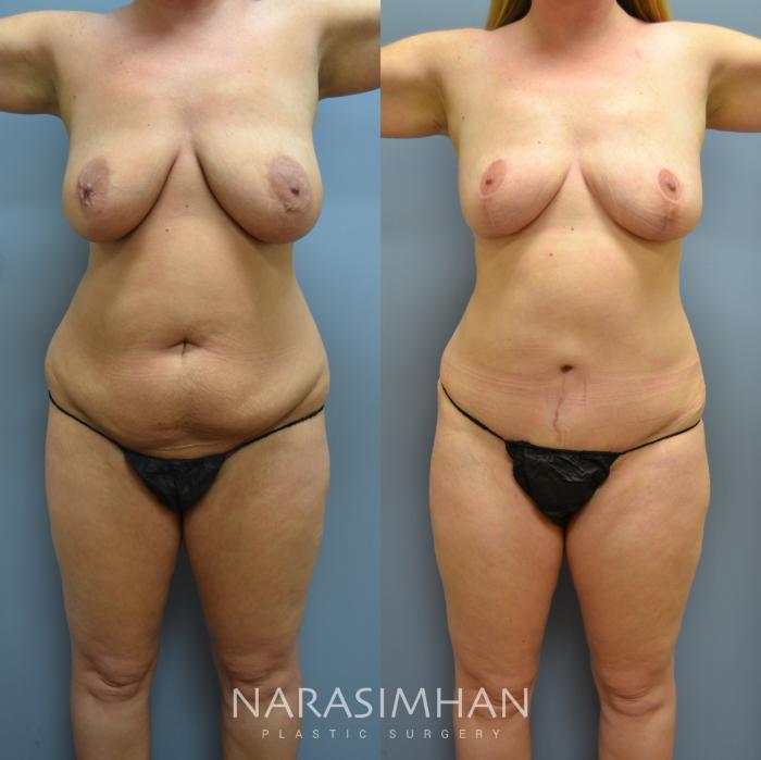 Before & After Tummy Tuck (Abdominoplasty) Case 10 View #1 View in Tampa, Florida