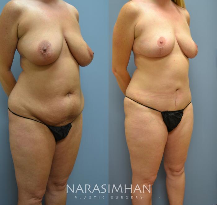 Before & After Tummy Tuck (Abdominoplasty) Case 10 View #2 View in Tampa, Florida