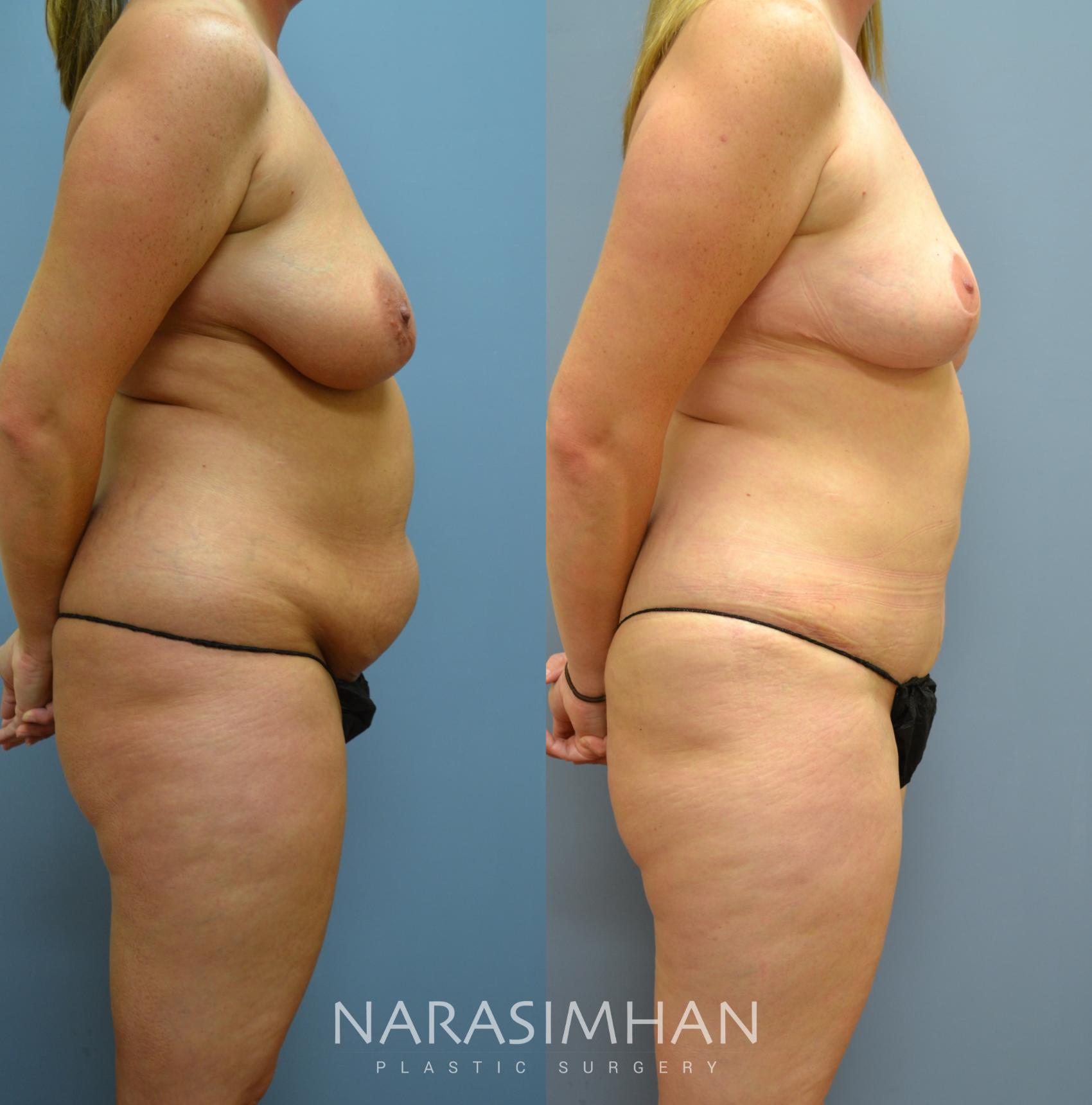 Before & After Mommy Makeover Case 10 View #3 View in St Petersburg, Florida