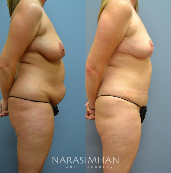 Before & After Tummy Tuck (Abdominoplasty) Case 10 View #3 View in Tampa, Florida