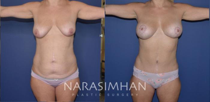 Before & After Breast Augmentation with Lift (Mastopexy) Case 178 View #1 View in St Petersburg, Florida