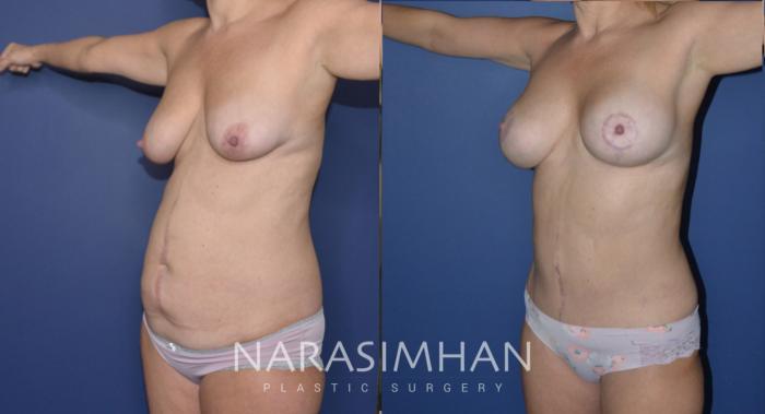 Before & After Breast Augmentation with Lift (Mastopexy) Case 178 View #3 View in St Petersburg, Florida