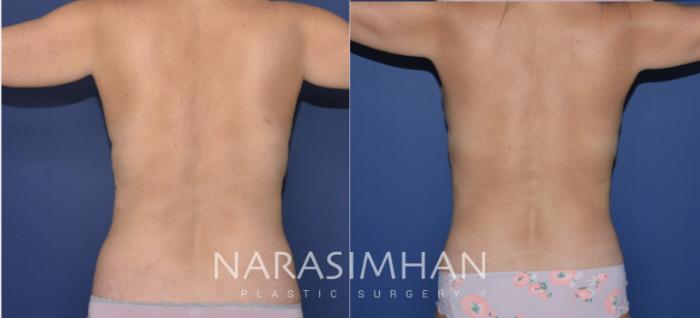 Before & After Breast Augmentation with Lift (Mastopexy) Case 178 View #4 View in St Petersburg, Florida